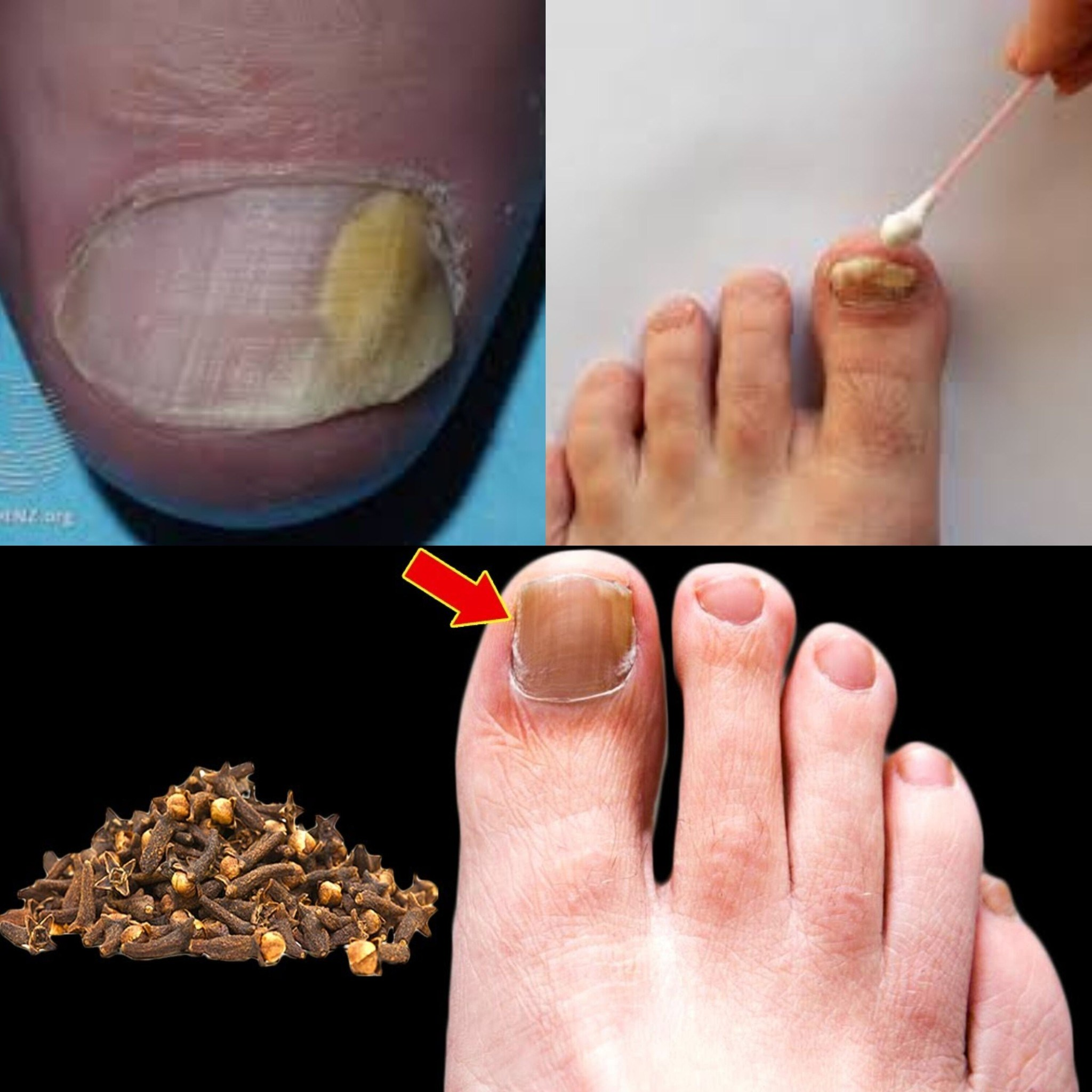 Clove Oil: A Natural Remedy for Nail Fungus