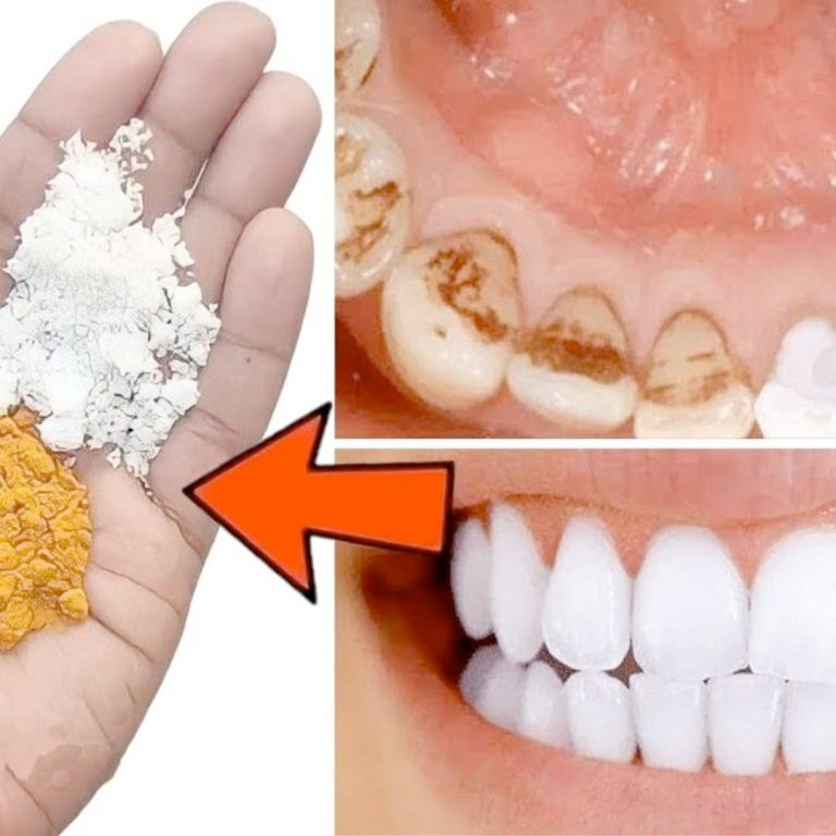 The Quick At-Home Teeth Whitening Secret